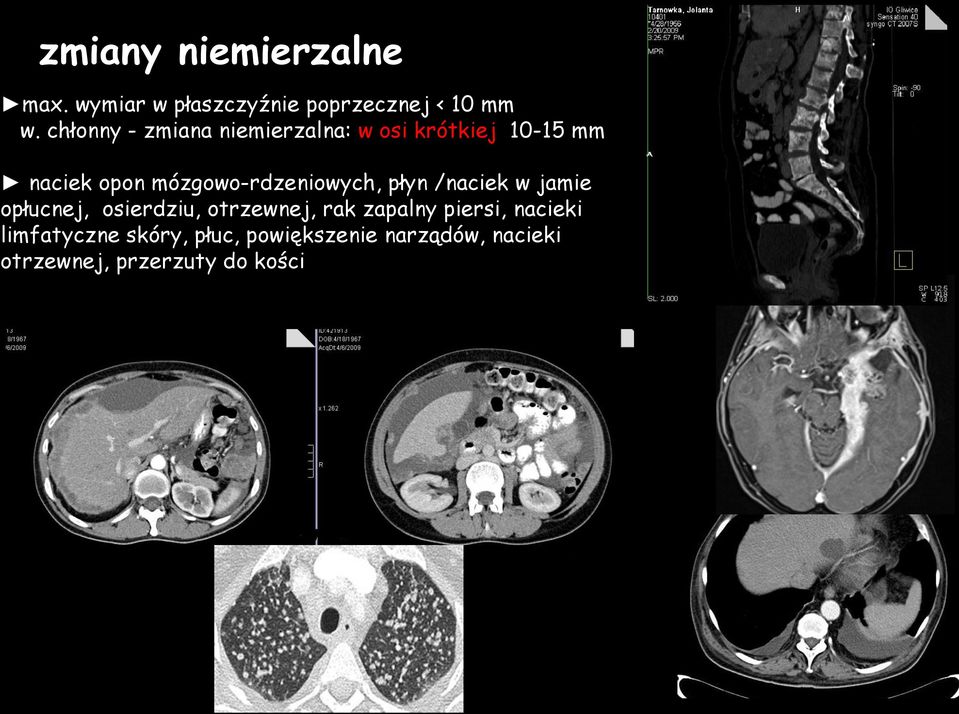 mózgowo-rdzeniowych, płyn /naciek w jamie opłucnej, osierdziu, otrzewnej, rak