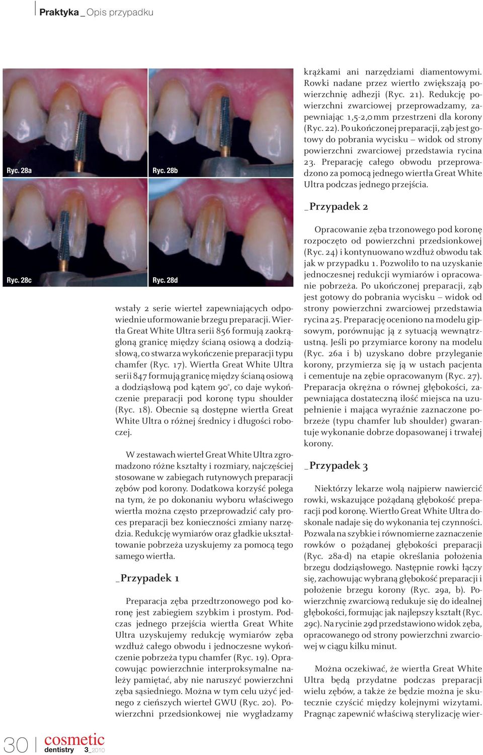 Wiertła Great White Ultra serii 847 formują granicę między ścianą osiową a dodziąsłową pod kątem 90, co daje wykończenie preparacji pod koronę typu shoulder (Ryc. 18).