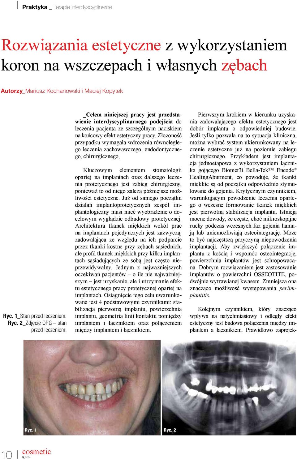 Złożoność przypadku wymagała wdrożenia równoległego leczenia zachowawczego, endodontycznego, chirurgicznego, Kluczowym elementem stomatologii opartej na implantach oraz dalszego leczenia