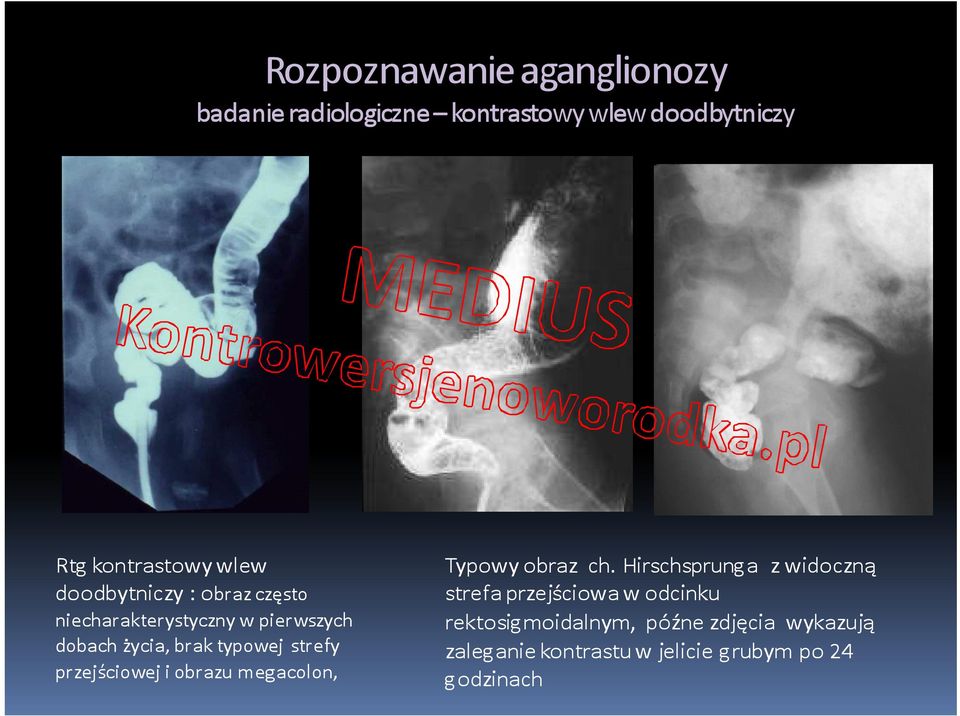 strefy przejściowej i obrazu megacolon, Typowy obraz ch.