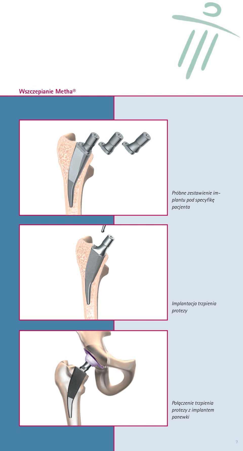 Implantacja trzpienia protezy