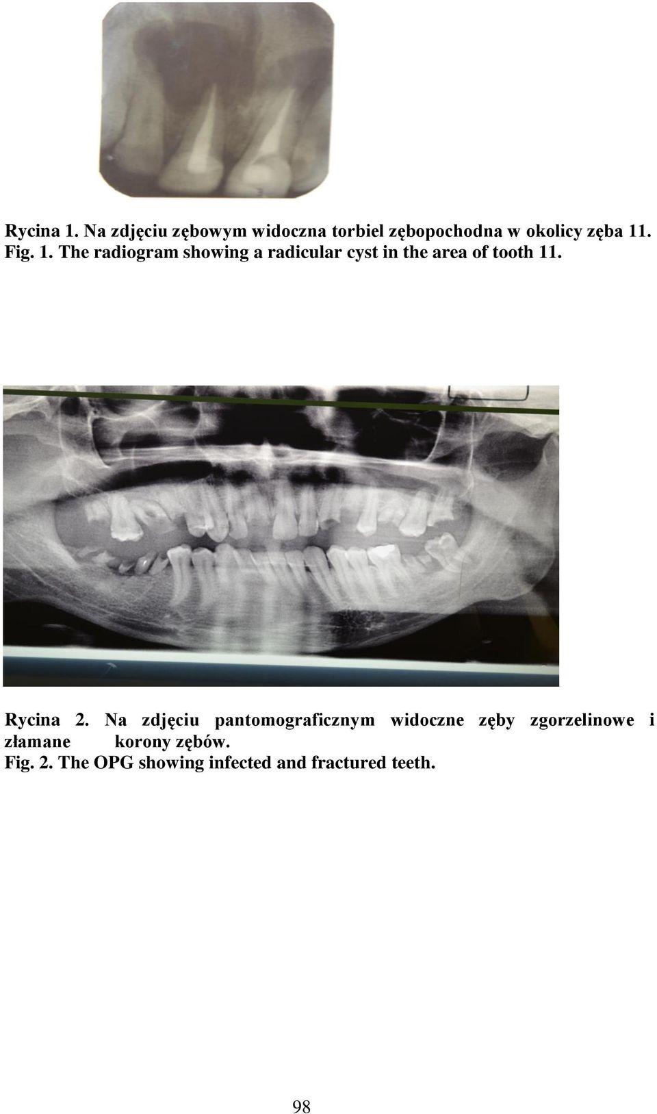 1. The radiogram showing a radicular cyst in the area of tooth 11.
