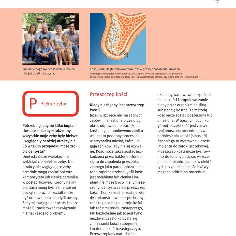 ) P Pi kne z by Potrzebuj jedynie kilku implantów, ale chcia bym tak e aby wszystkie moje z by by y bielsze i wyglàda y bardziej atrakcyjnie. Co w takim przypadku mo e zrobiç dentysta?
