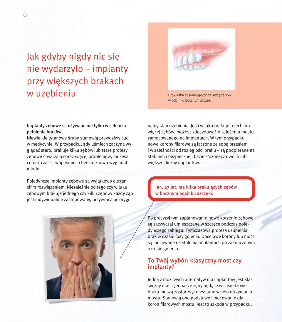 W przypadku, gdy uêmiech zaczyna wyglàdaç staro, brakuje kilku z bów lub stare protezy z bowe stwarzajà coraz wi cej problemów, mo esz cofnàç czas i Twój uêmiech b dzie znowu wyglàda m odo.