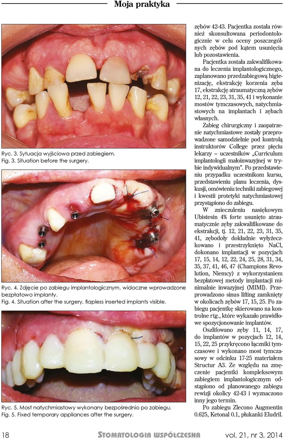 Pacjentka została również skonsultowana periodontologicznie w celu oceny poszczególnych zębów pod kątem usunięcia lub pozostawienia.