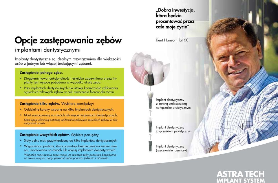 Przy implantach dentystycznych nie istnieje konieczność szlifowania sąsiednich zdrowych zębów w celu stworzenia filarów dla mostu. Zastąpienie kilku zębów.