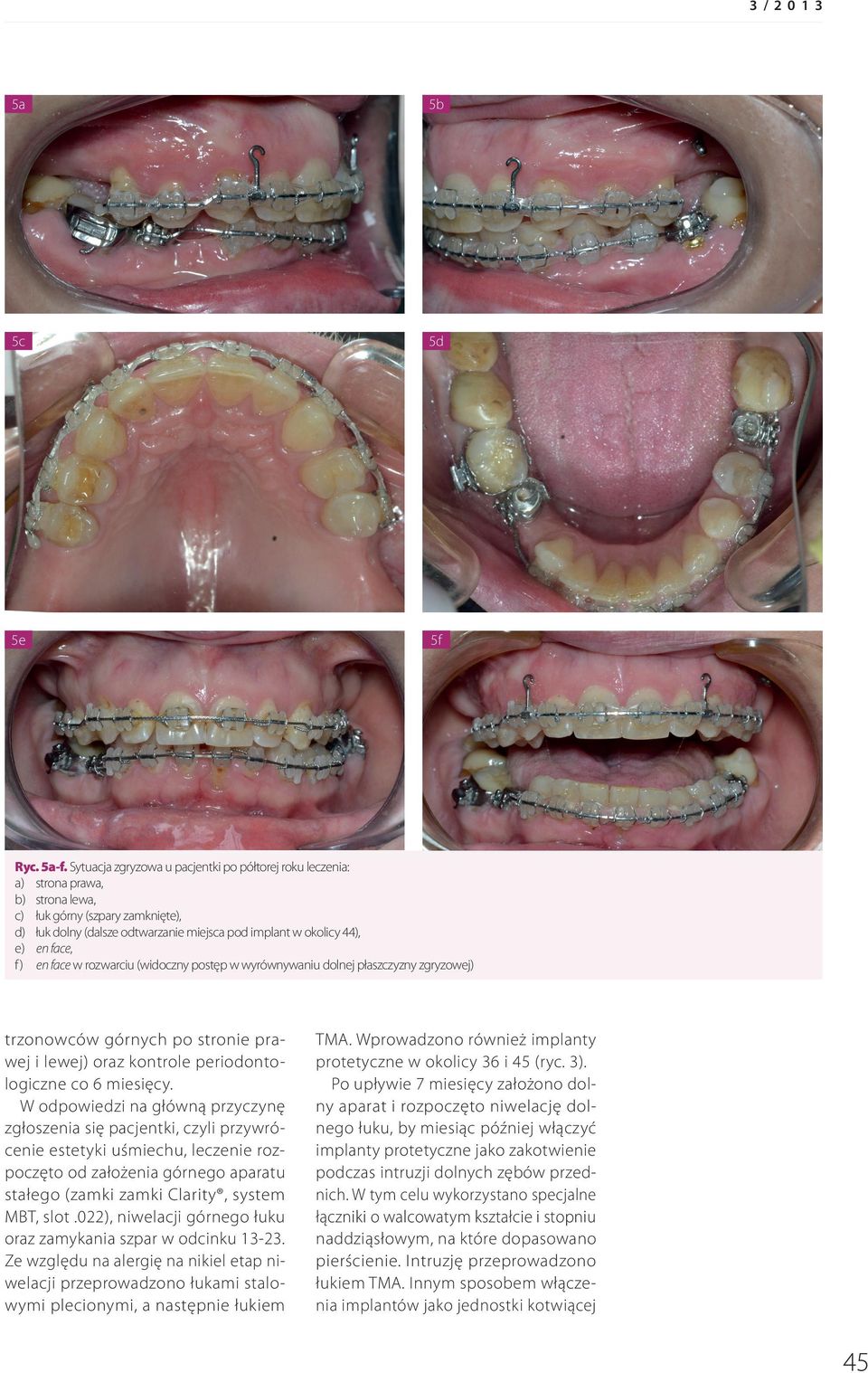 face, f) en face w rozwarciu (widoczny postęp w wyrównywaniu dolnej płaszczyzny zgryzowej) trzonowców górnych po stronie prawej i lewej) oraz kontrole periodontologiczne co 6 miesięcy.