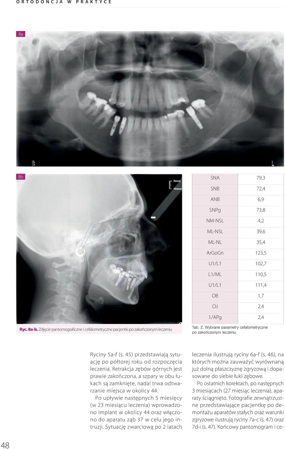45) przedstawiają sytuację po półtorej roku od rozpoczęcia leczenia. Retrakcja zębów górnych jest prawie zakończona, a szpary w obu łukach są zamknięte, nadal trwa odtwarzanie miejsca w okolicy 44.