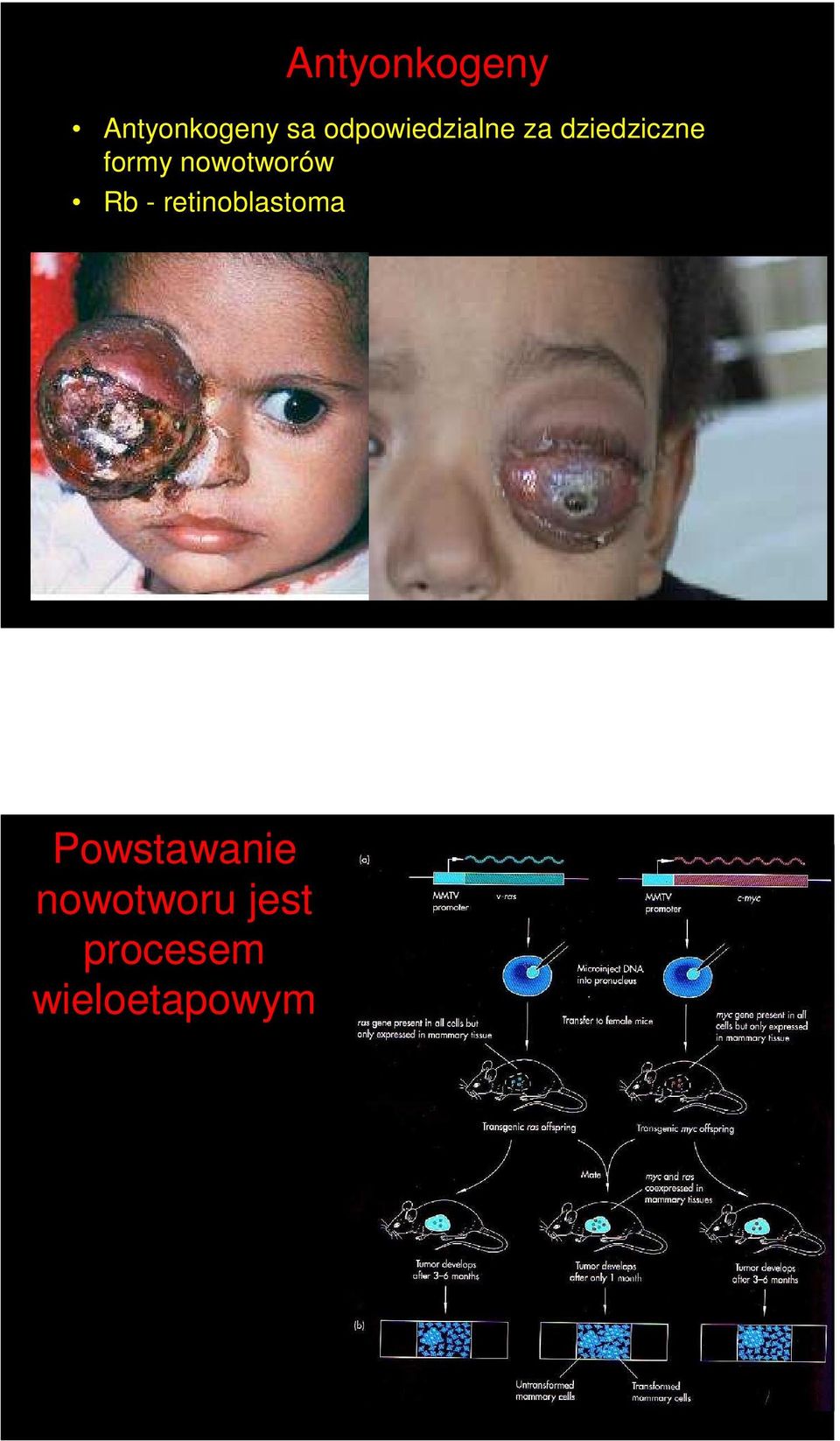 nowotworów Rb - retinoblastoma