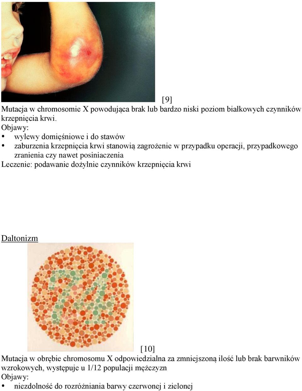 nawet posiniaczenia Leczenie: podawanie dożylnie czynników krzepnięcia krwi Daltonizm [10] Mutacja w obrębie chromosomu X