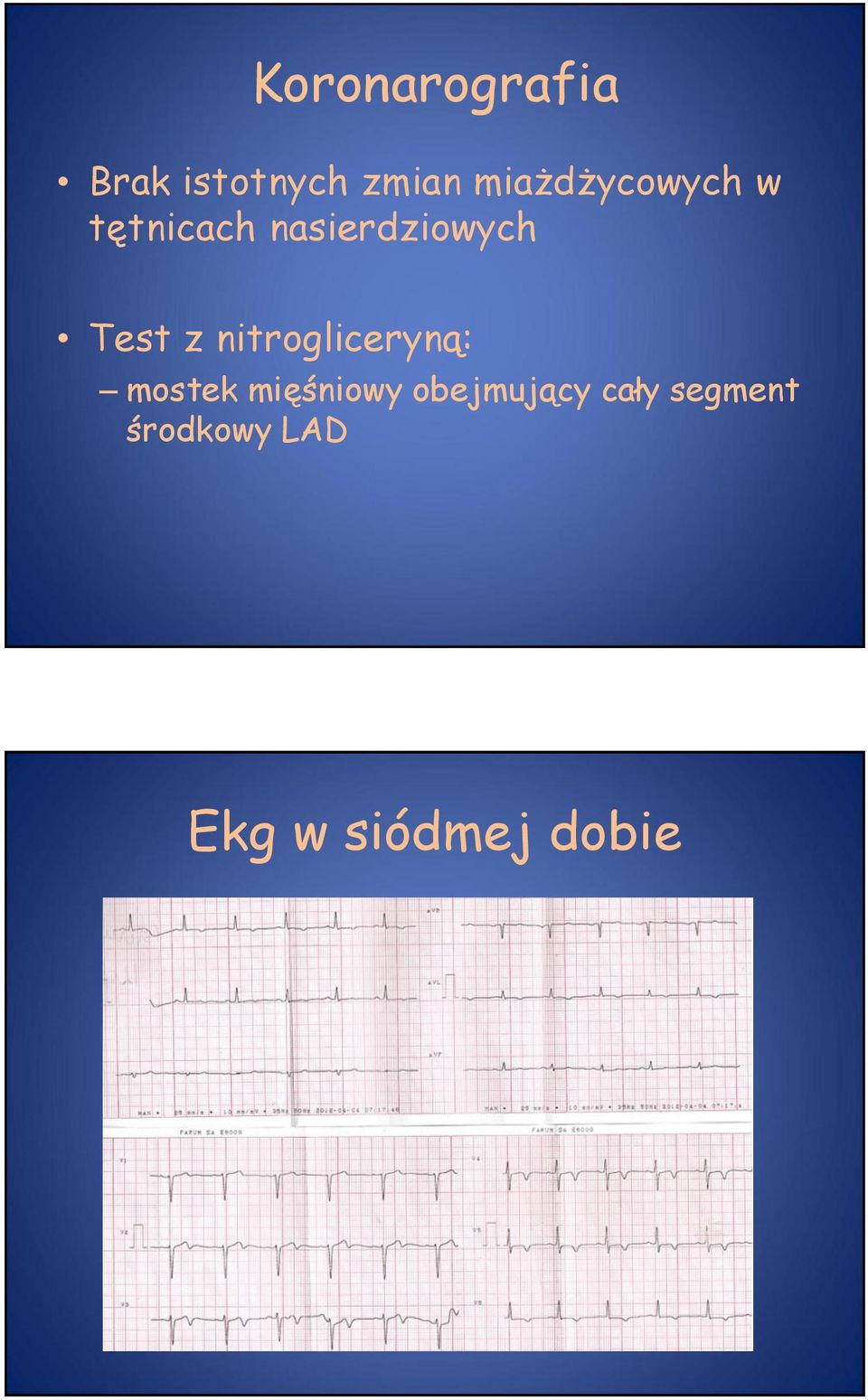 Test z nitrogliceryną: mostek mięśniowy