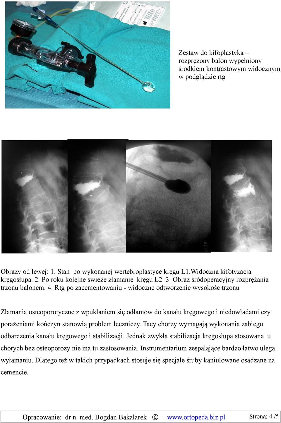 Rtg po zacementowaniu - widoczne odtworzenie wysokośc trzonu Złamania osteoporotyczne z wpuklaniem się odłamów do kanału kręgowego i niedowładami czy porażeniami kończyn stanowią problem leczniczy.