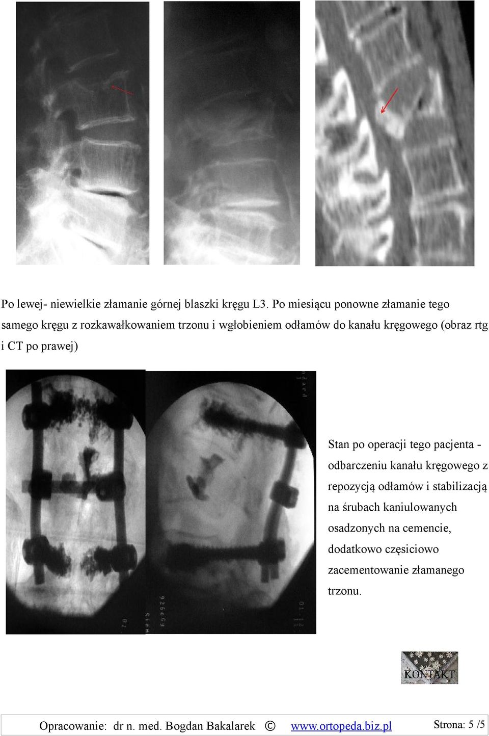 (obraz rtg i CT po prawej) Stan po operacji tego pacjenta - odbarczeniu kanału kręgowego z repozycją odłamów i