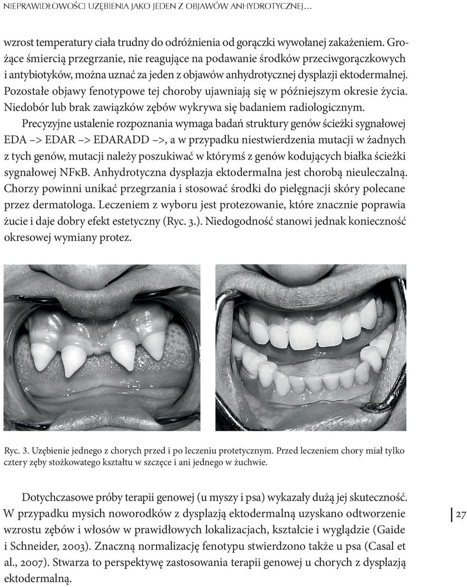 Pozostałe objawy fenotypowe tej choroby ujawniają się w późniejszym okresie życia. Niedobór lub brak zawiązków zębów wykrywa się badaniem radiologicznym.