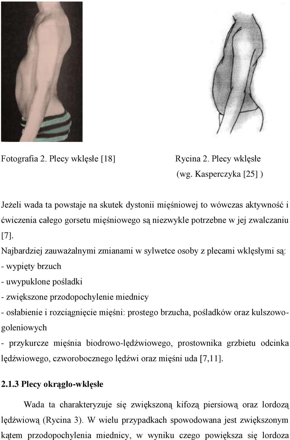 Najbardziej zauważalnymi zmianami w sylwetce osoby z plecami wklęsłymi są: - wypięty brzuch - uwypuklone pośladki - zwiększone przodopochylenie miednicy - osłabienie i rozciągnięcie mięśni: prostego