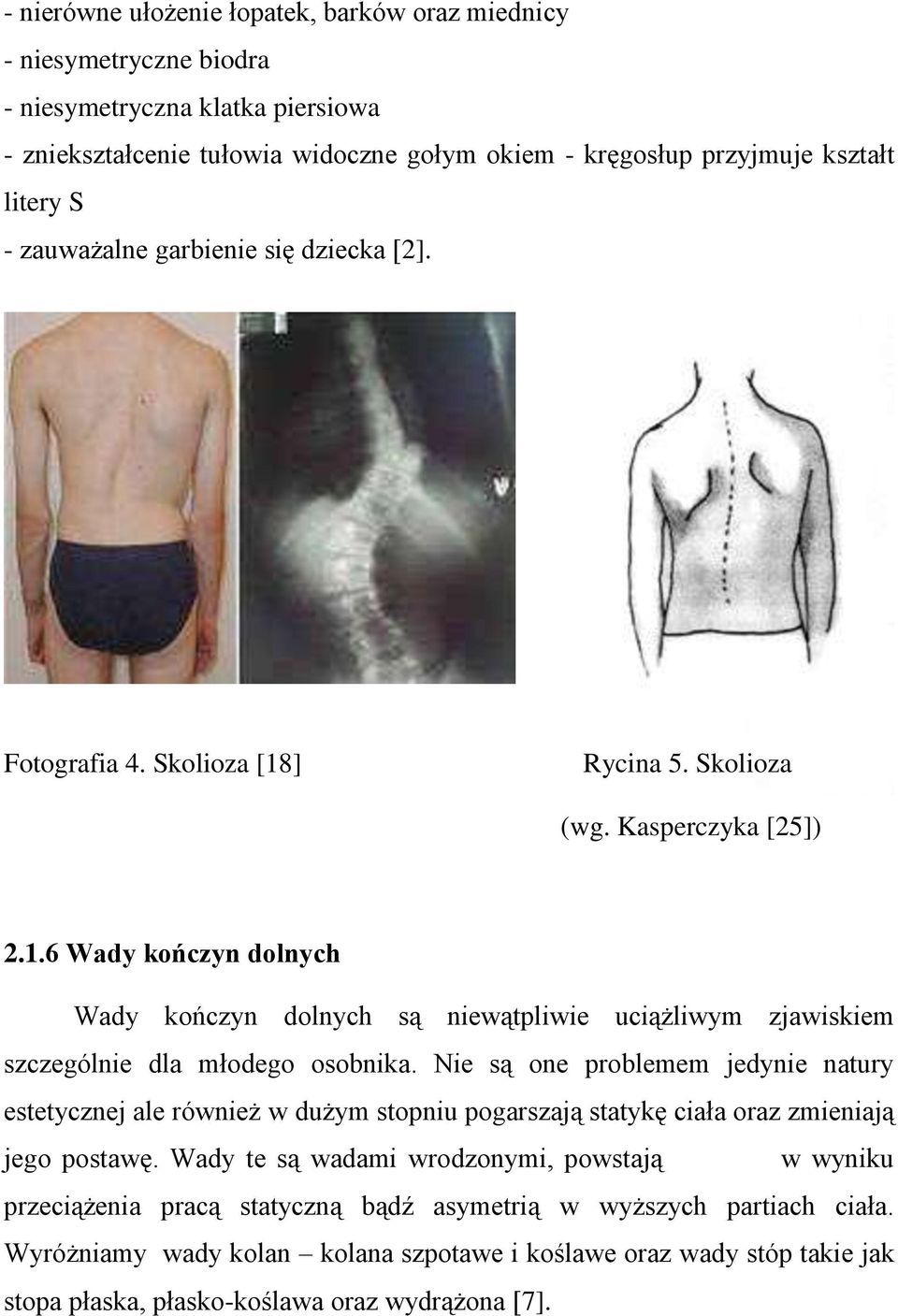 Nie są one problemem jedynie natury estetycznej ale również w dużym stopniu pogarszają statykę ciała oraz zmieniają jego postawę.