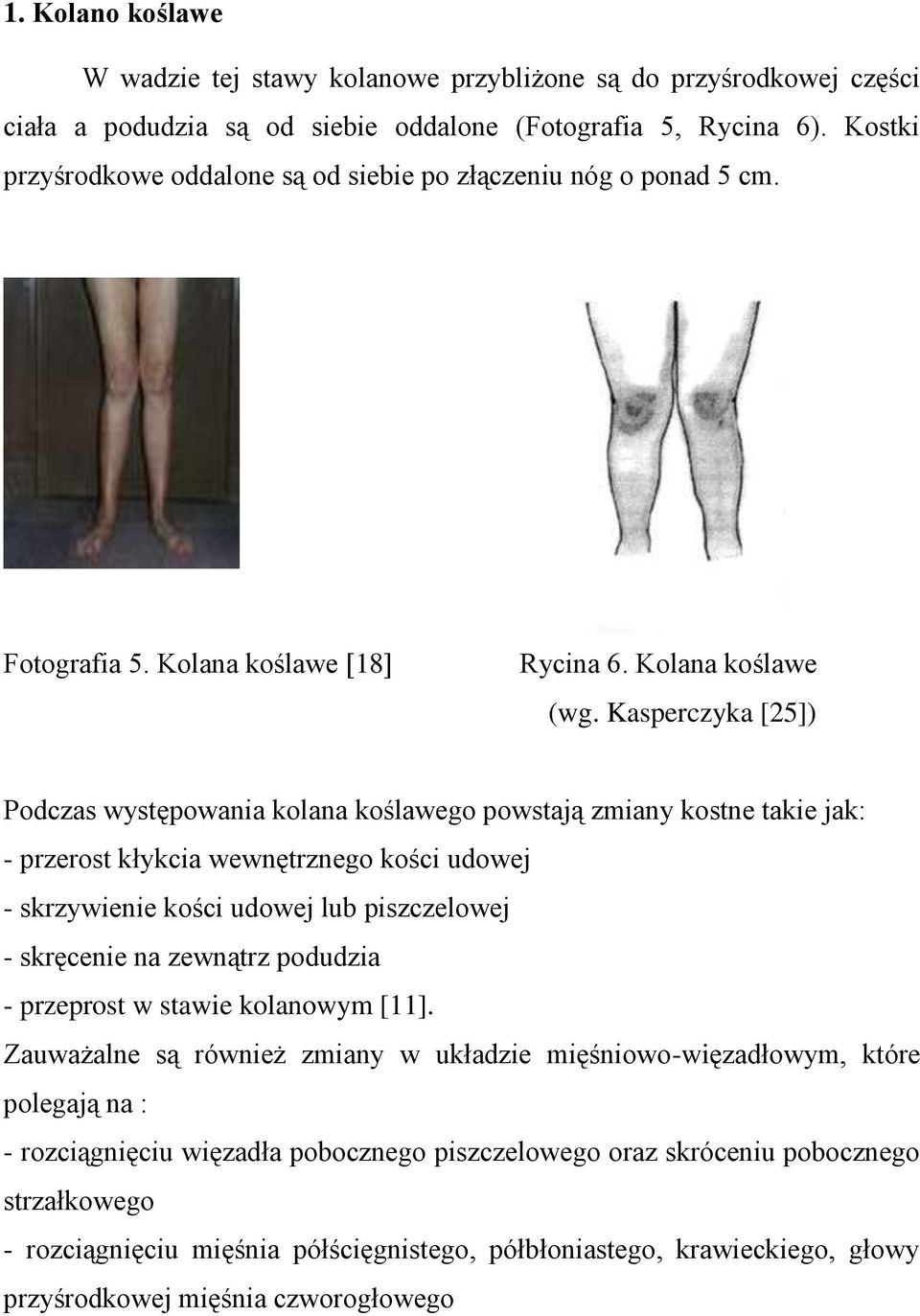 Kasperczyka [25]) Podczas występowania kolana koślawego powstają zmiany kostne takie jak: - przerost kłykcia wewnętrznego kości udowej - skrzywienie kości udowej lub piszczelowej - skręcenie na