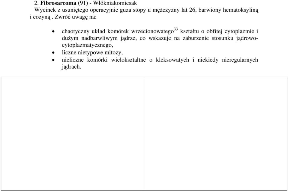 Zwróć uwagę na: chaotyczny układ komórek wrzecionowatego 33 kształtu o obfitej cytoplazmie i dużym