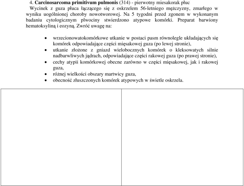 Zwróć uwagę na: wrzecionowatokomórkowe utkanie w postaci pasm równolegle układających się komórek odpowiadające części mięsakowej guza (po lewej stronie), utkanie złożone z gniazd wielobocznych