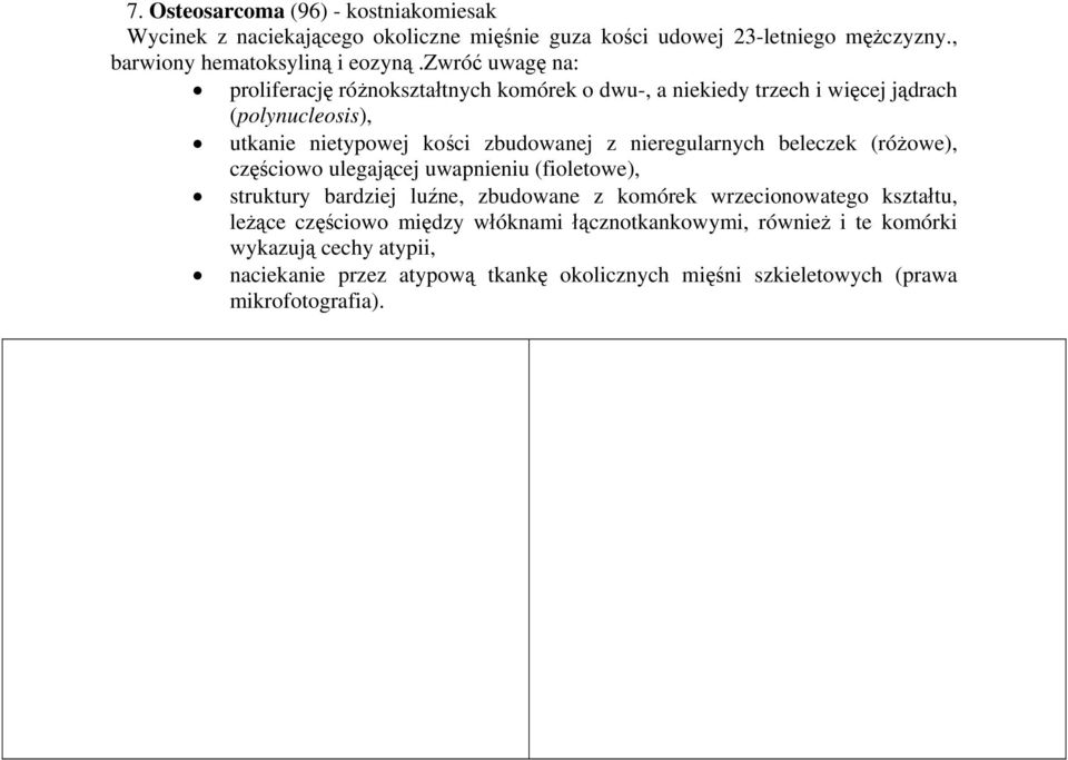 nieregularnych beleczek (różowe), częściowo ulegającej uwapnieniu (fioletowe), struktury bardziej luźne, zbudowane z komórek wrzecionowatego kształtu, leżące
