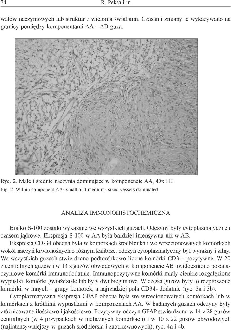 Within component AA- small and medium- sized vessels dominated Analiza immunohistochemiczna Białko S-100 zostało wykazane we wszystkich guzach. Odczyny były cytoplazmatyczne i czasem jądrowe.