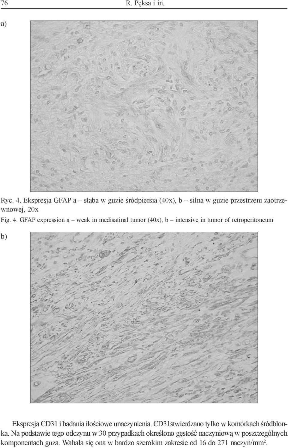 GFAP expression a weak in medisatinal tumor (40x), b intensive in tumor of retroperitoneum b) Ekspresja CD31 i badania