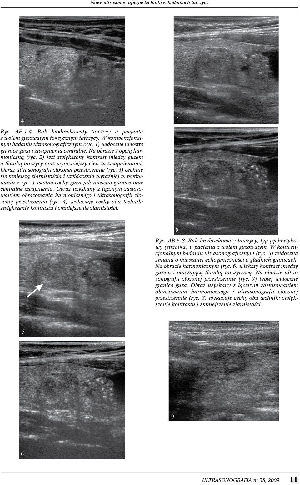Obraz ultrasonografii złożonej przestrzennie (ryc. 3) cechuje się mniejszą ziarnistością i uwidacznia wyraźniej w porównaniu z ryc. 1 istotne cechy guza jak nieostre granice oraz centralne zwapnienia.