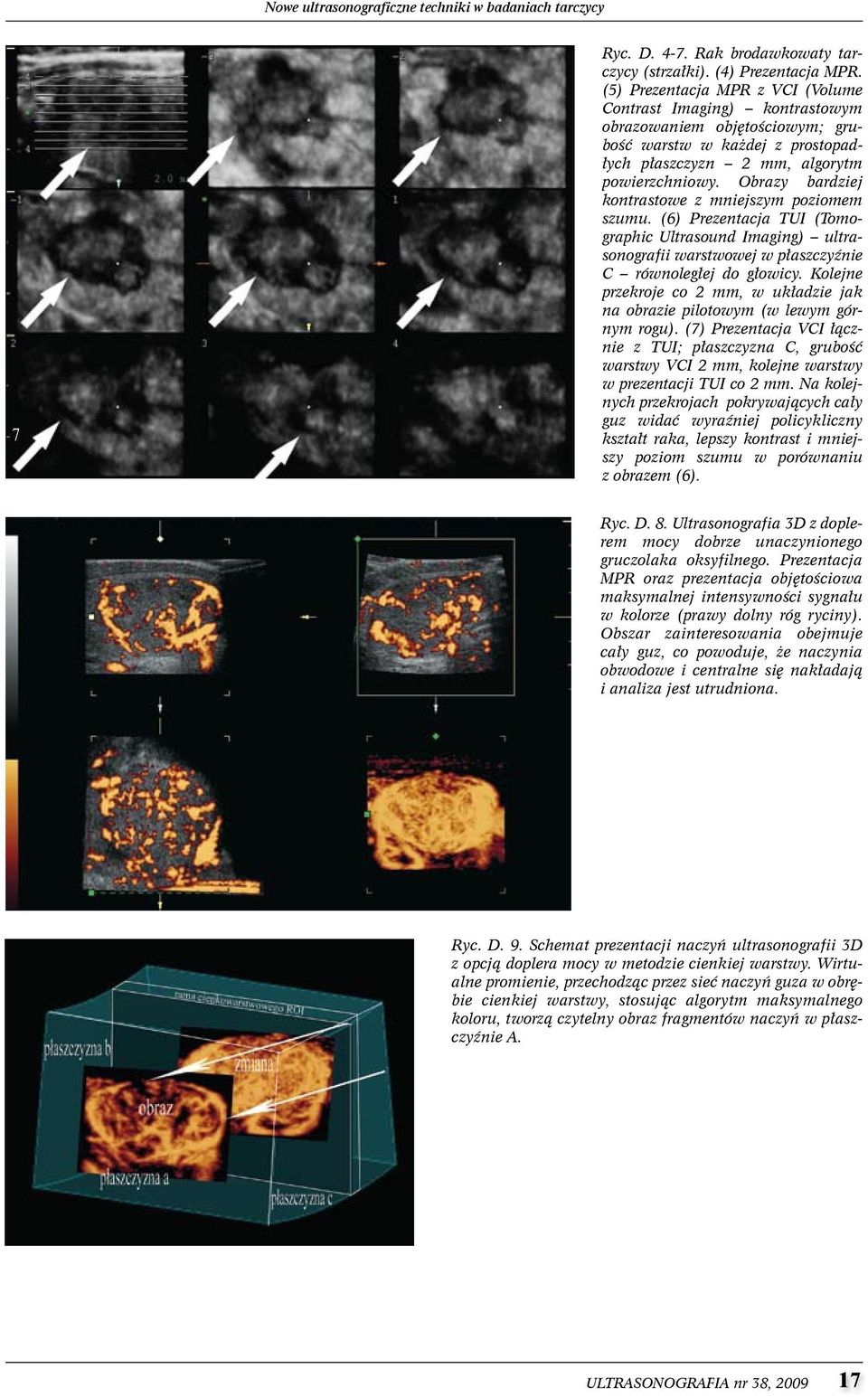 Obrazy bardziej kontrastowe z mniejszym poziomem szumu. (6) Prezentacja TUI (Tomographic Ultrasound Imaging) ultrasonografii warstwowej w płaszczyźnie C równoległej do głowicy.