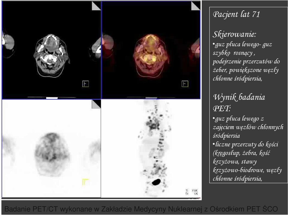 lewego z zajęciem węzłów chłonnych śródpiersia liczne przerzuty do kości