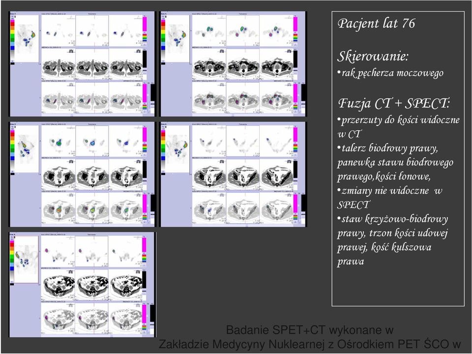 widoczne w SPECT staw krzyŝowo-biodrowy prawy, trzon kości udowej prawej, kość kulszowa