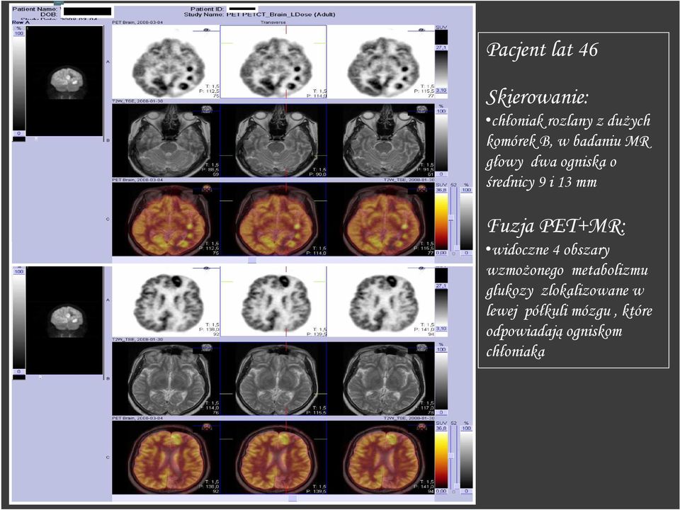 PET+MR: widoczne 4 obszary wzmoŝonego metabolizmu glukozy