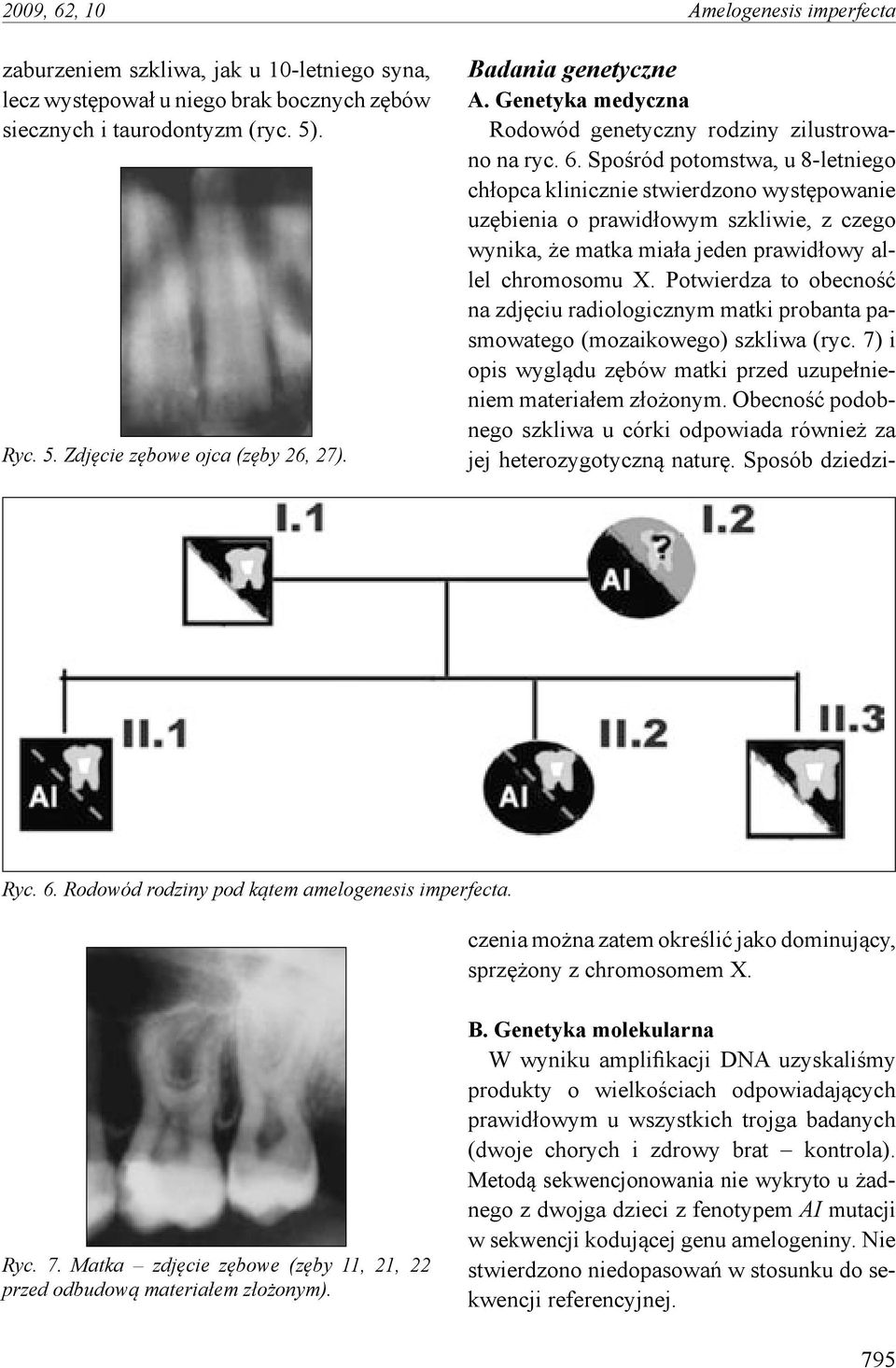 Potwierdza to obecność na zdjęciu radiologicznym matki probanta pasmowatego (mozaikowego) szkliwa (ryc. 7) i opis wyglądu zębów matki przed uzupełnieniem materiałem złożonym.
