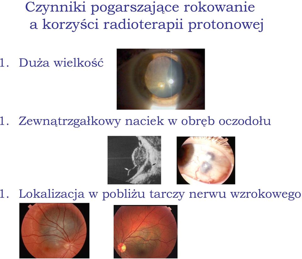 Zewnątrzgałkowy naciek w obręb oczodołu 1.