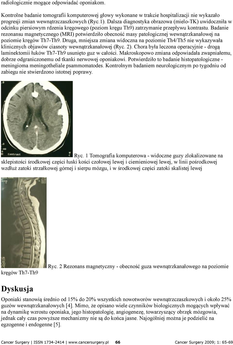Badanie rezonansu magnetycznego (MRI) potwierdziło obecność masy patologicznej wewnątrzkanałowej na poziomie kręgów Th7-Th9.