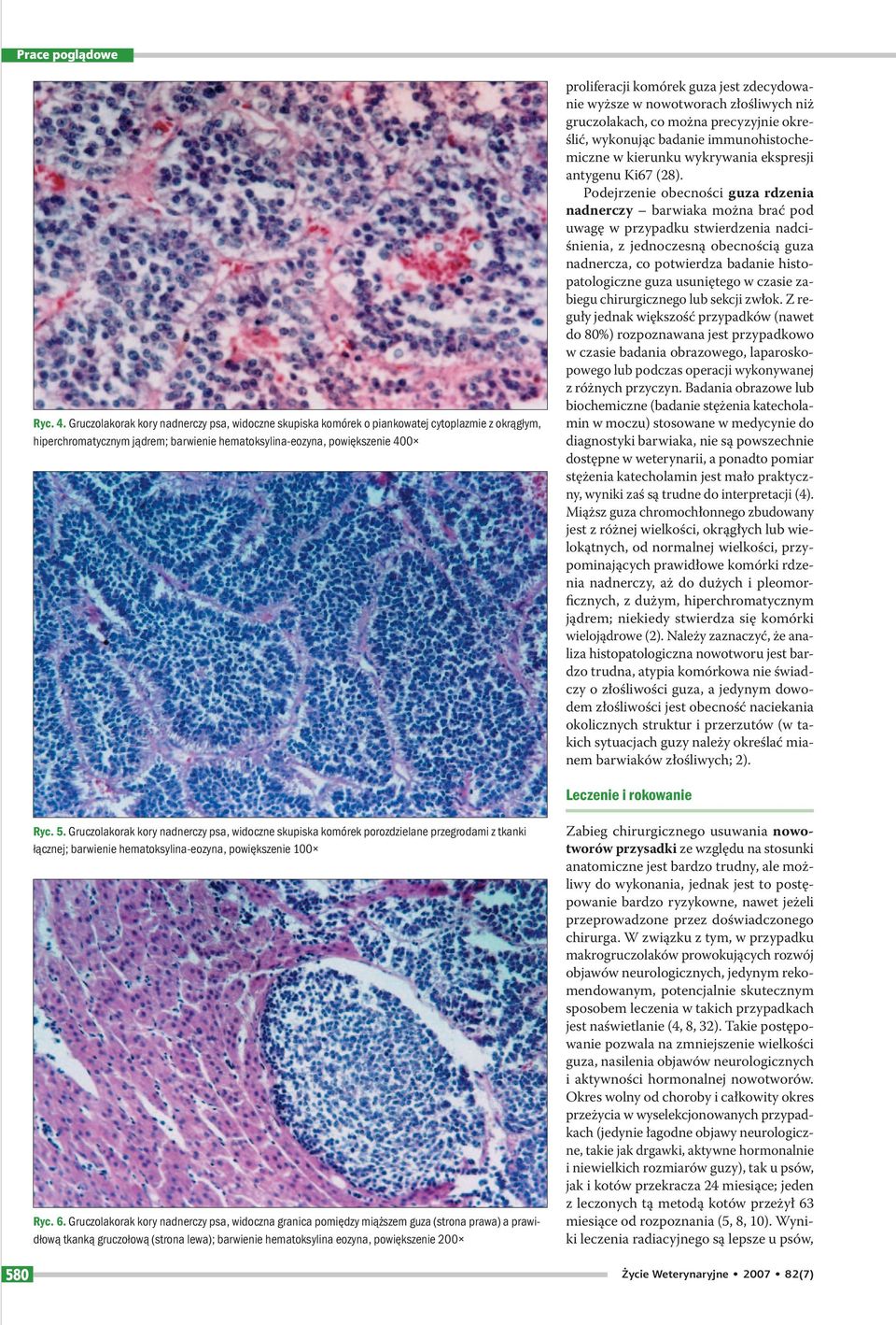 jest zdecydowanie wyższe w nowotworach złośliwych niż gruczolakach, co można precyzyjnie określić, wykonując badanie immunohistochemiczne w kierunku wykrywania ekspresji antygenu Ki67 (28).