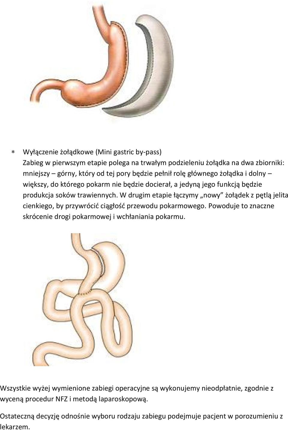 W drugim etapie łączymy nowy żołądek z pętlą jelita cienkiego, by przywrócić ciągłość przewodu pokarmowego. Powoduje to znaczne skrócenie drogi pokarmowej i wchłaniania pokarmu.