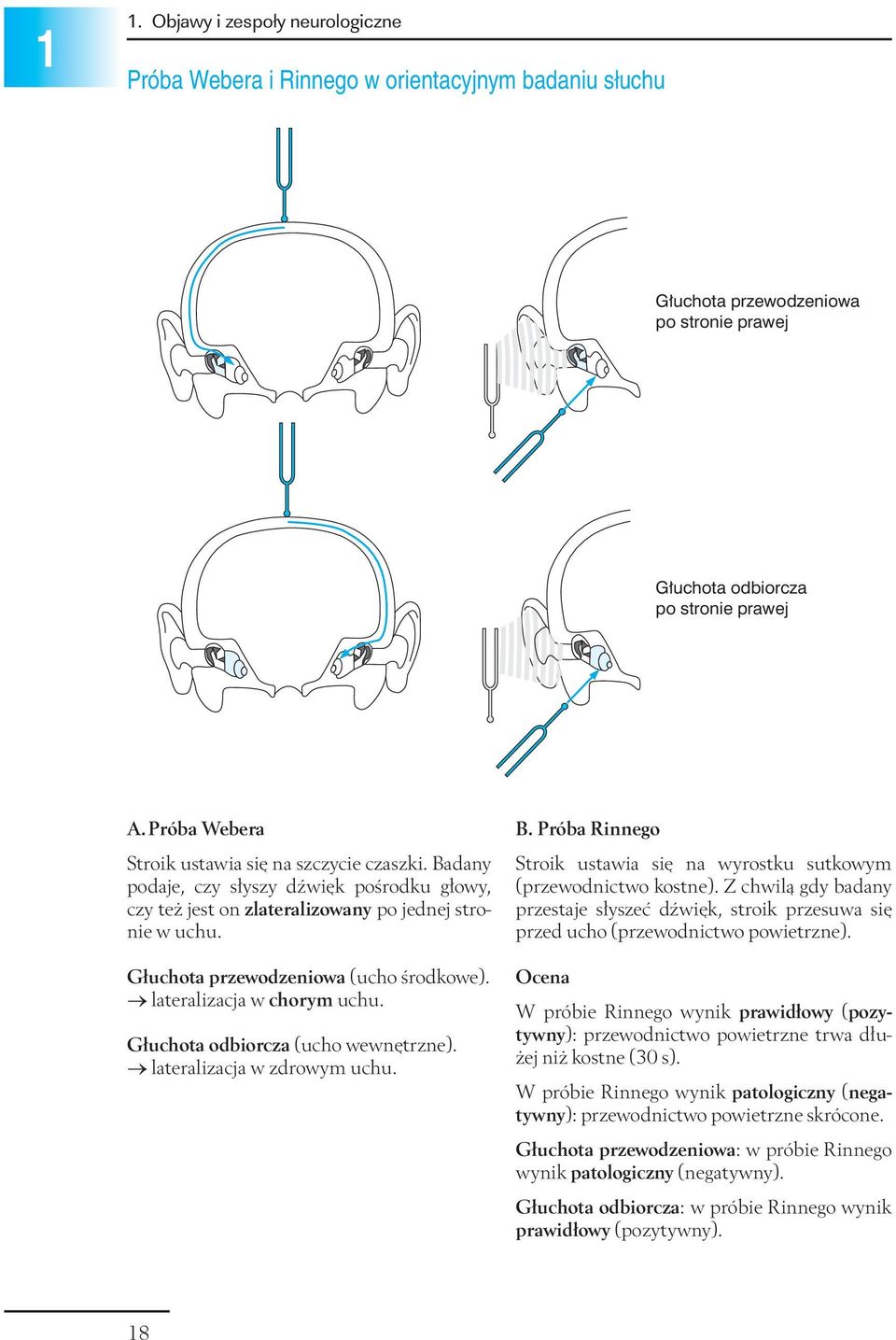 lateralizacja w chorym uchu. Głuchota odbiorcza (ucho wewnętrzne). lateralizacja w zdrowym uchu. B. Próba Rinnego Stroik ustawia się na wyrostku sutkowym (przewodnictwo kostne).