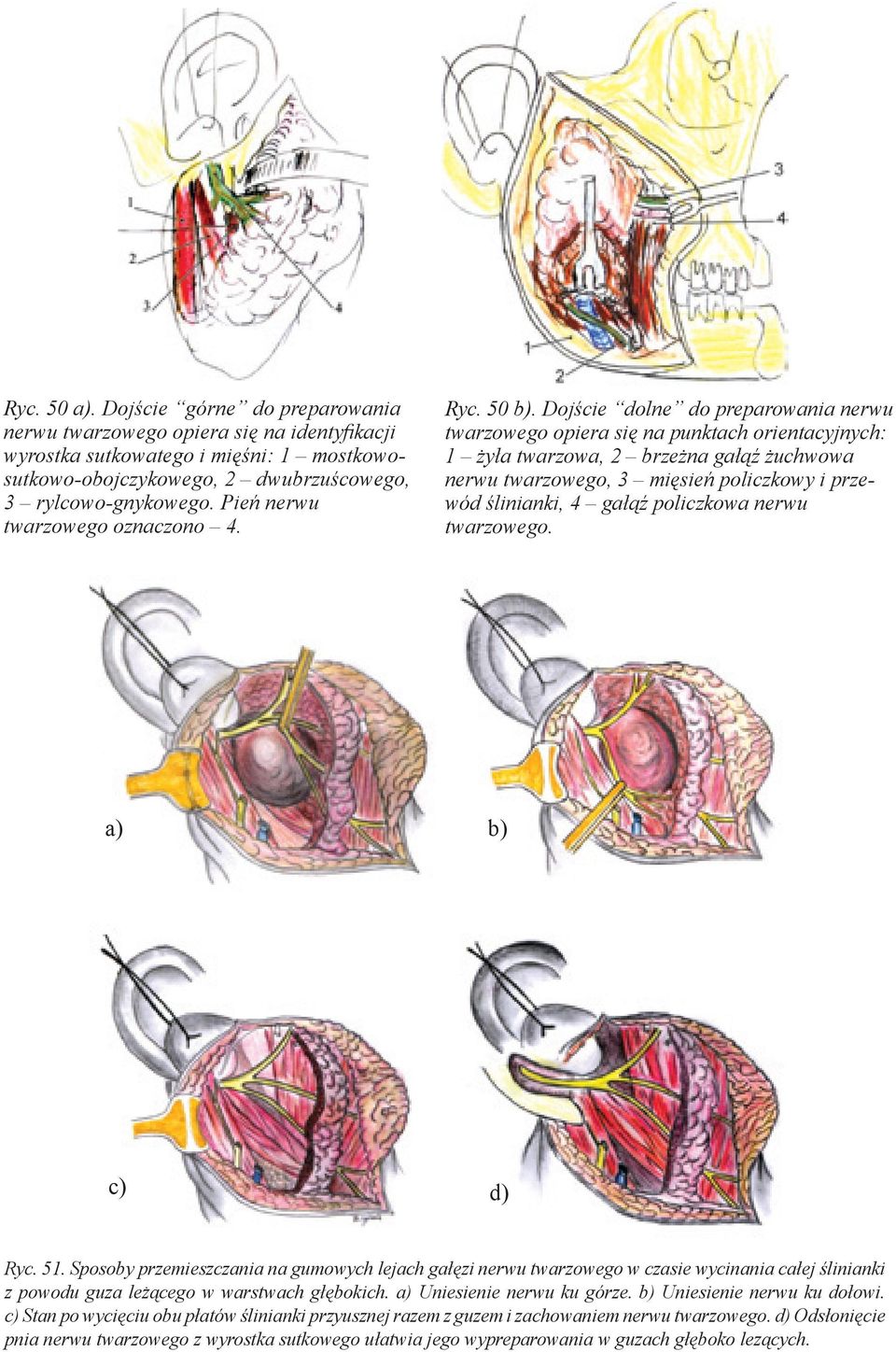 Dojście dolne do preparowania nerwu twarzowego opiera się na punktach orientacyjnych: 1 żyła twarzowa, 2 brzeżna gałąź żuchwowa nerwu twarzowego, 3 mięsień policzkowy i przewód ślinianki, 4 gałąź