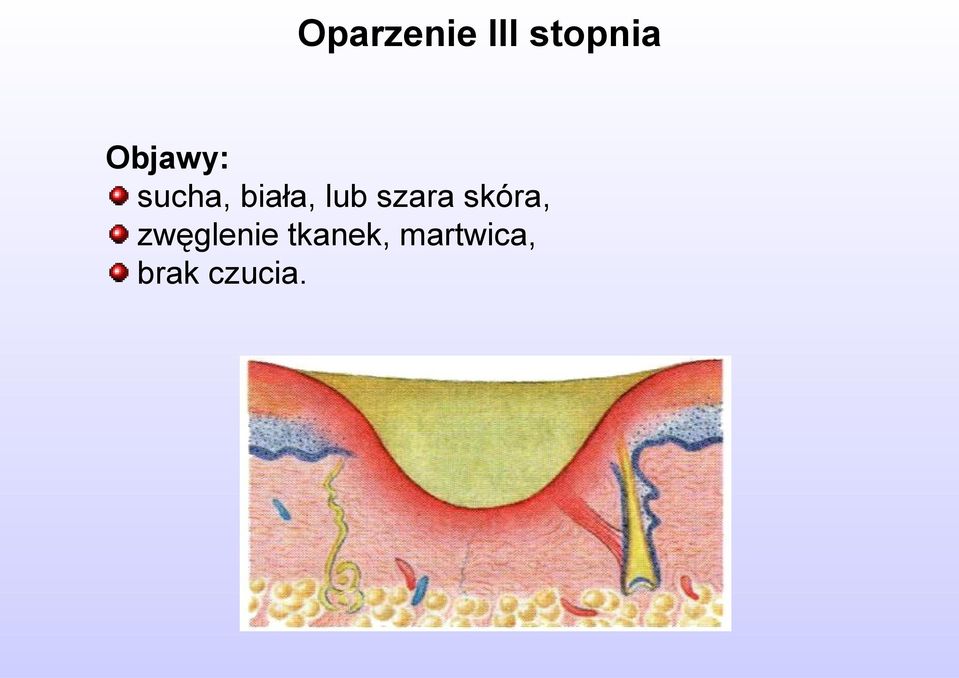 szara skóra, zwęglenie