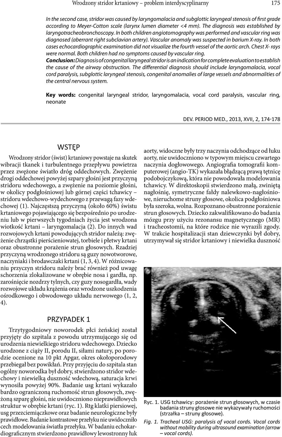 In both children angiotomography was performed and vascular ring was diagnosed (aberrant right subclavian artery). Vascular anomaly was suspected in barium X-ray.