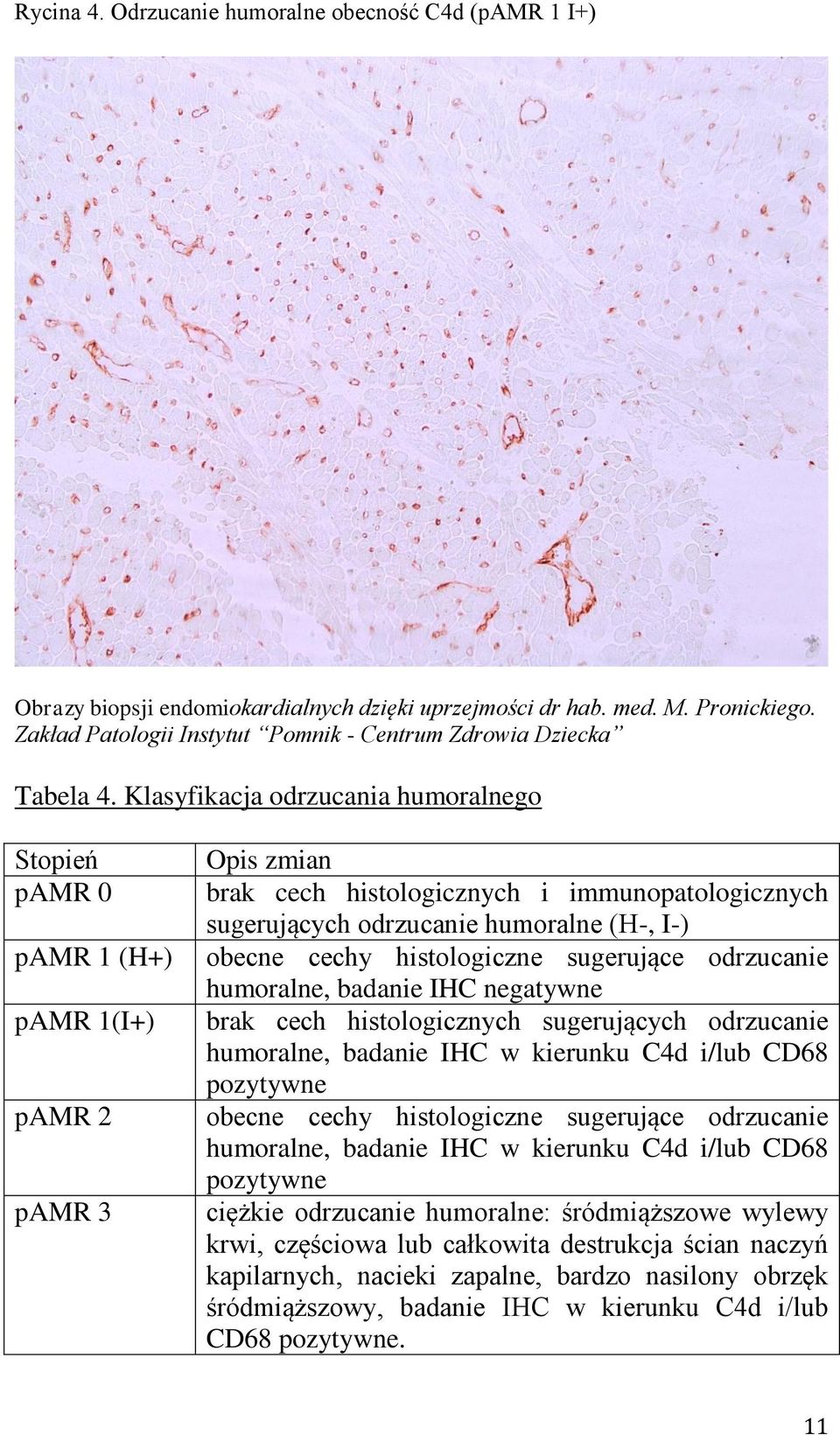Klasyfikacja odrzucania humoralnego Stopień pamr 0 pamr 1 (H+) pamr 1(I+) pamr 2 pamr 3 Opis zmian brak cech histologicznych i immunopatologicznych sugerujących odrzucanie humoralne (H-, I-) obecne