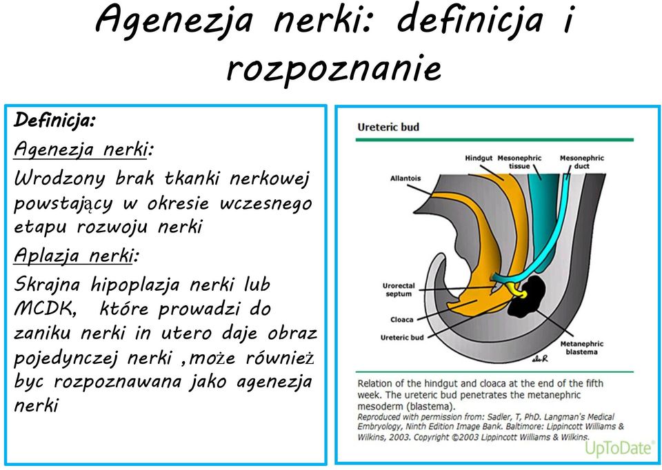 Skrajna hipoplazja nerki lub MCDK, które prowadzi do zaniku nerki in utero