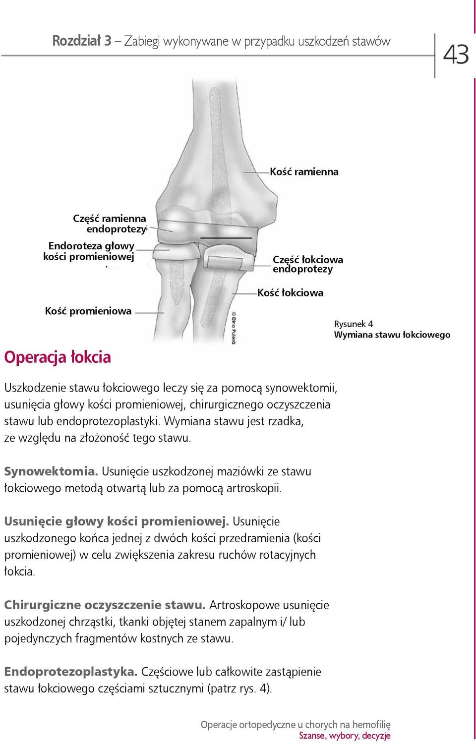 Wymiana stawu jest rzadka, ze względu na złożoność tego stawu. Synowektomia. Usunięcie uszkodzonej maziówki ze stawu łokciowego metodą otwartą lub za pomocą artroskopii.