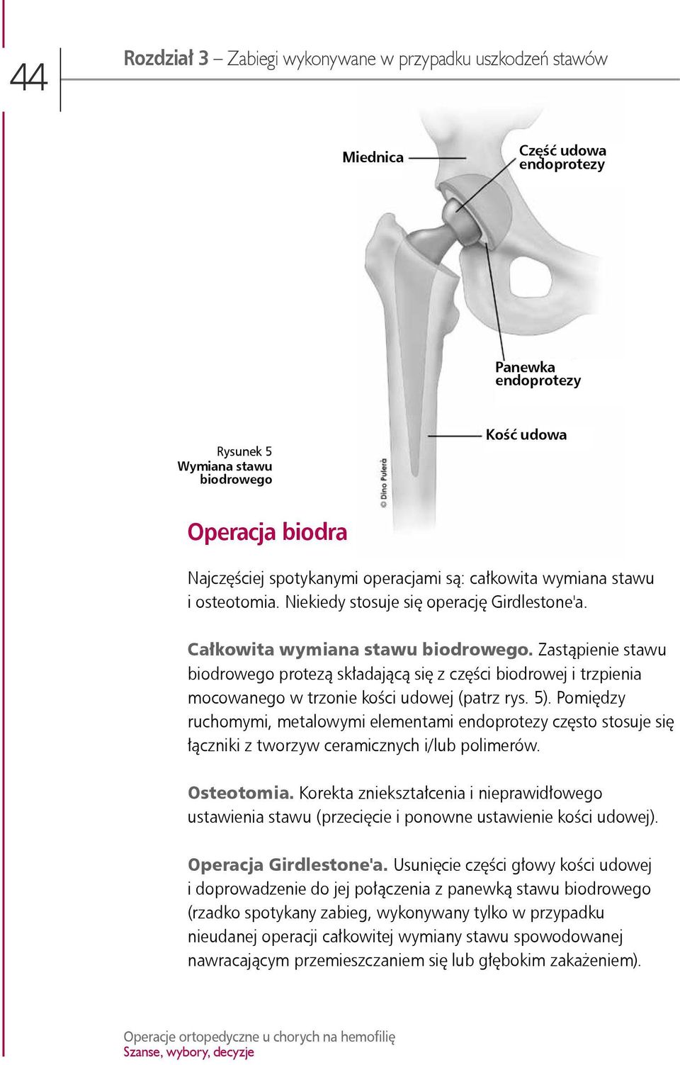 Zastąpienie stawu biodrowego protezą składającą się z części biodrowej i trzpienia mocowanego w trzonie kości udowej (patrz rys. 5).