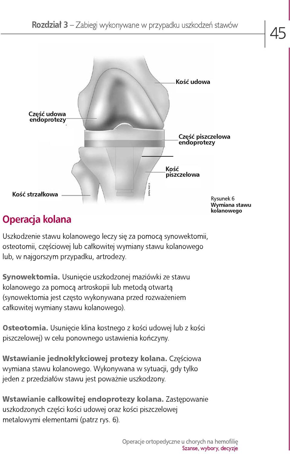 Usunięcie uszkodzonej maziówki ze stawu kolanowego za pomocą artroskopii lub metodą otwartą (synowektomia jest często wykonywana przed rozważeniem całkowitej wymiany stawu kolanowego). Osteotomia.