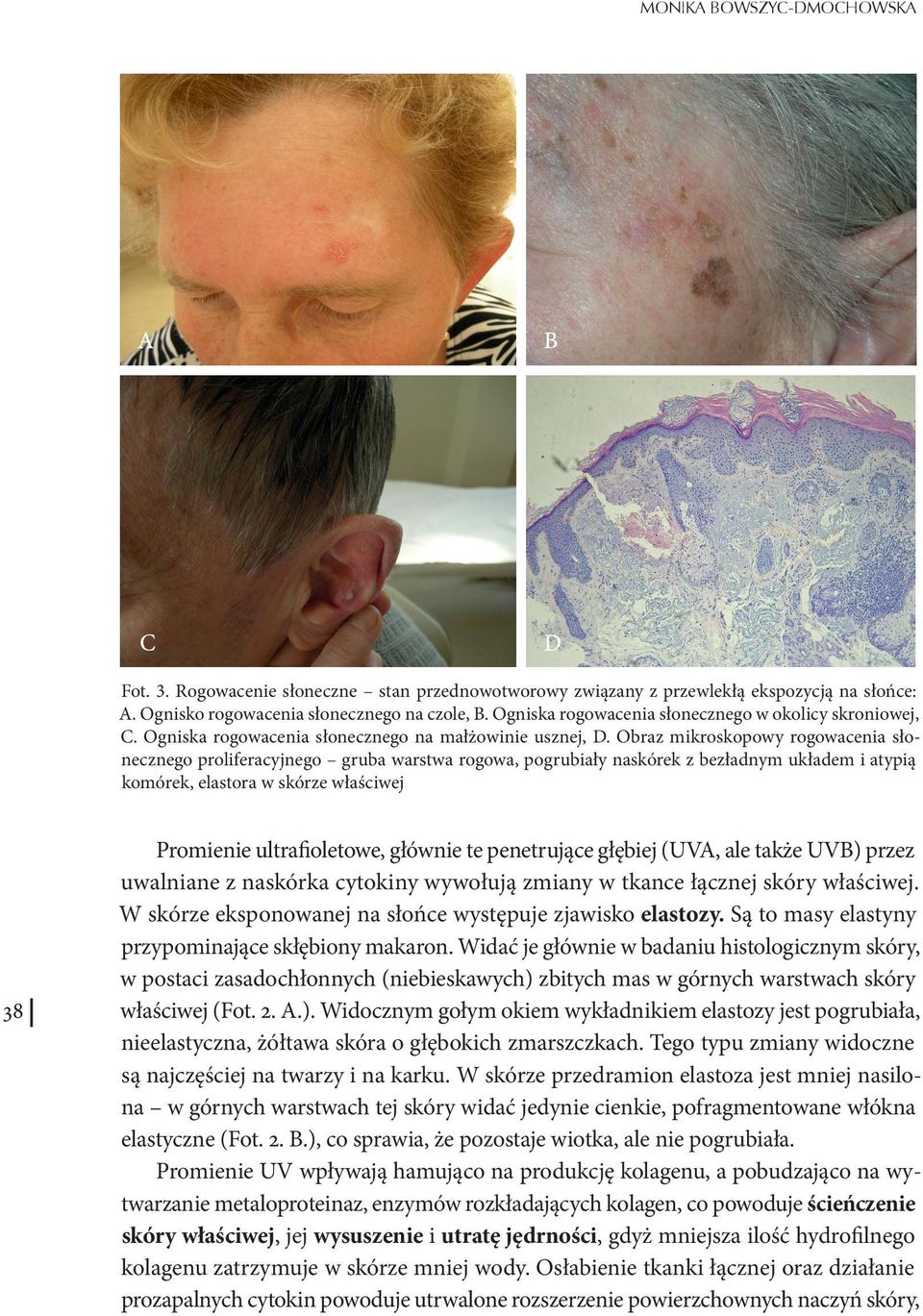 Obraz mikroskopowy rogowacenia słonecznego proliferacyjnego gruba warstwa rogowa, pogrubiały naskórek z bezładnym układem i atypią komórek, elastora w skórze właściwej 38 Promienie ultrafioletowe,