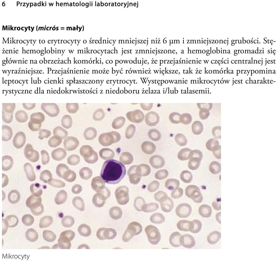 Stężenie hemoglobiny w mikrocytach jest zmniejszone, a hemoglobina gromadzi się głównie na obrzeżach komórki, co powoduje, że