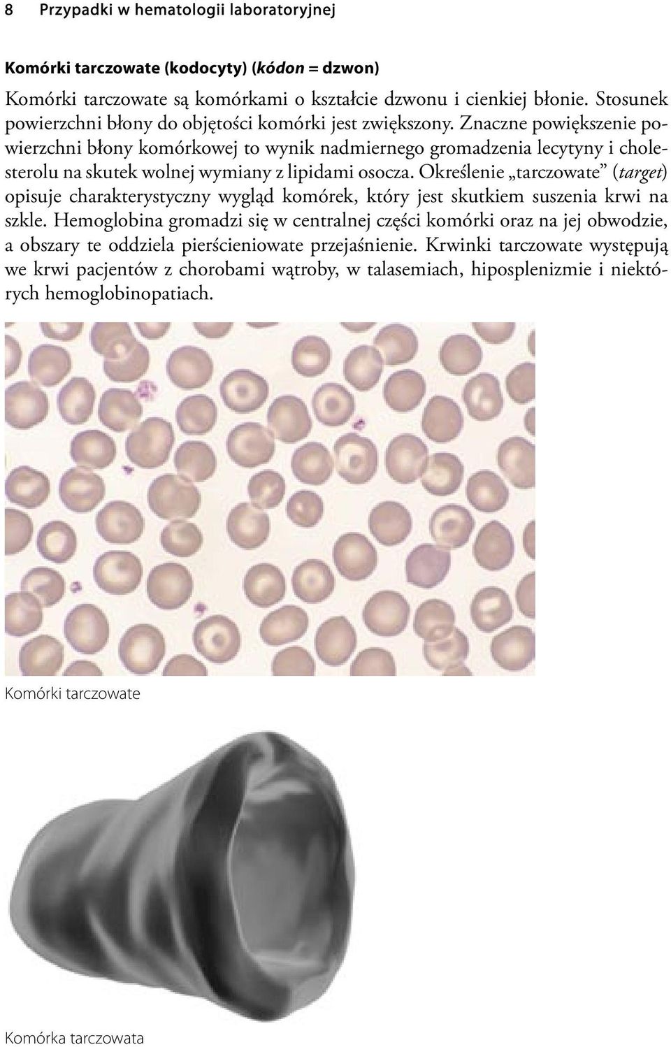 Znaczne powiększenie powierzchni błony komórkowej to wynik nadmiernego gromadzenia lecytyny i cholesterolu na skutek wolnej wymiany z lipidami osocza.