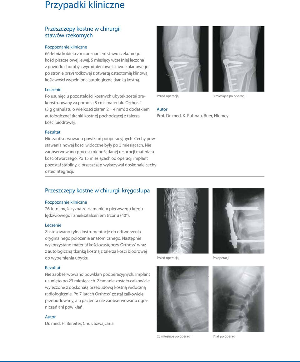 Leczenie Po usunięciu pozostałości kostnych ubytek został zrekonstruowany za pomocą 8 cm 3 materiału Orthoss (3 g granulatu o wielkosci ziaren 2 4 mm) z dodatkiem autologicznej tkanki kostnej