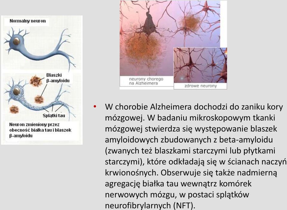 beta-amyloidu (zwanych też blaszkami starczymi lub płytkami starczymi), które odkładają się w ścianach